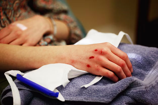 درمان زخم تروماتیک