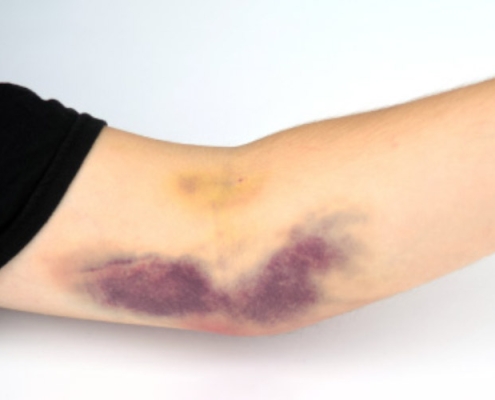 درمان زخم بسته