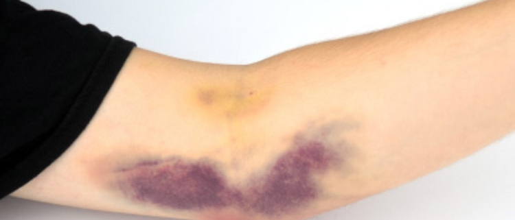 درمان زخم بسته