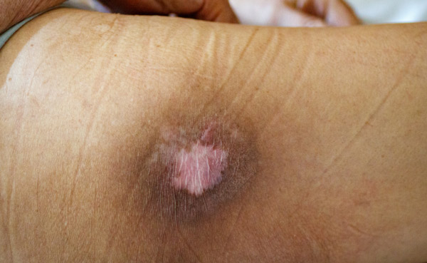 درمان زخم بسته