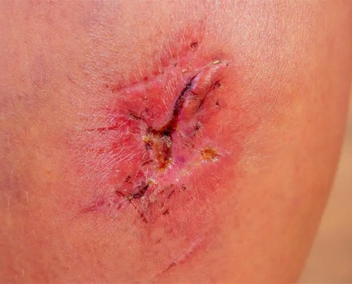 درمان زخم عمیق