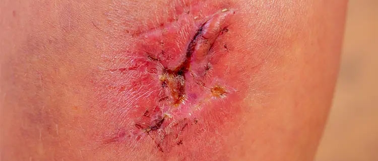 درمان زخم عمیق