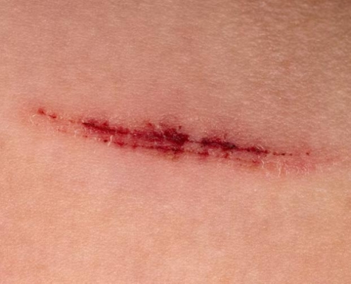 درمان زخم سطحی