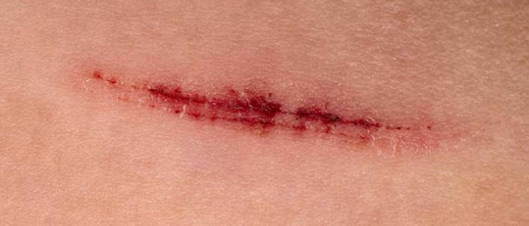 درمان زخم سطحی