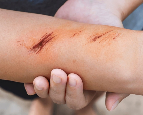 درمان انواع زخم