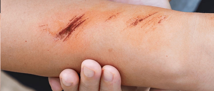 درمان انواع زخم