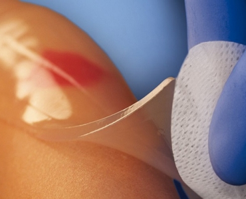 پانسمان مرطوب چیست؟