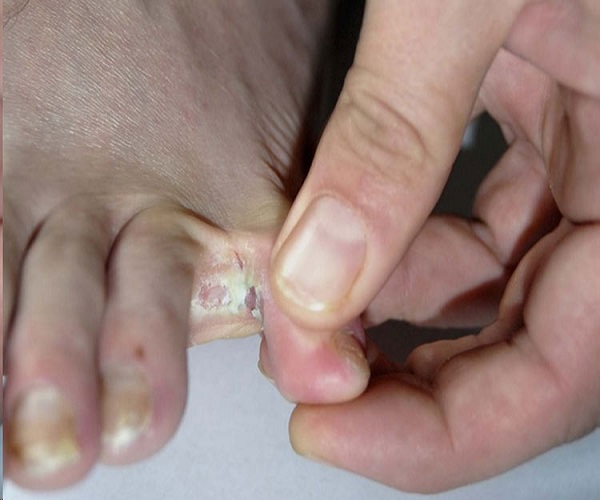 زخم لای انگشت پا