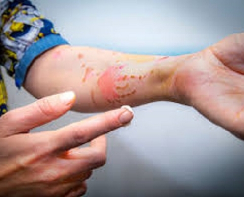 درمان زخم بدون بخیه