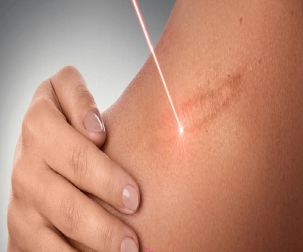 درمان زخم بدون بخیه