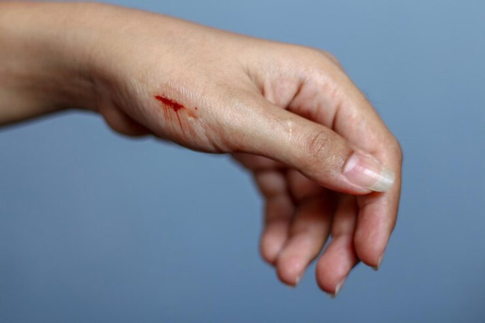 درمان زخم بریدگی