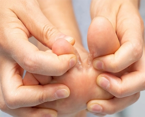 زخم لای انگشت پا