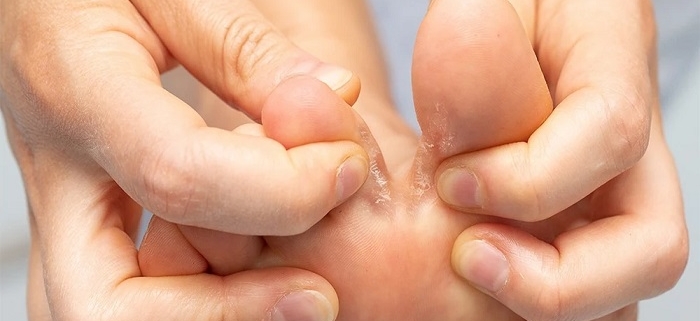 زخم لای انگشت پا