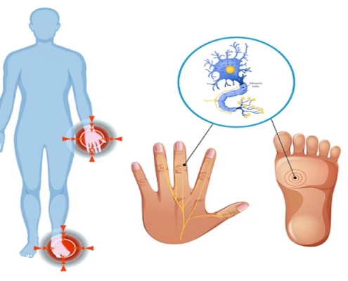 زخم‌های نوروپاتیک