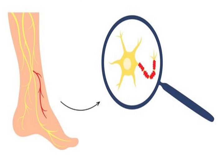 زخم نوروپاتیک