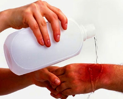 شستشوی زخم در خانه