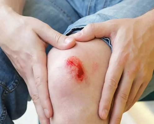 نحوه درمان زخم تازه
