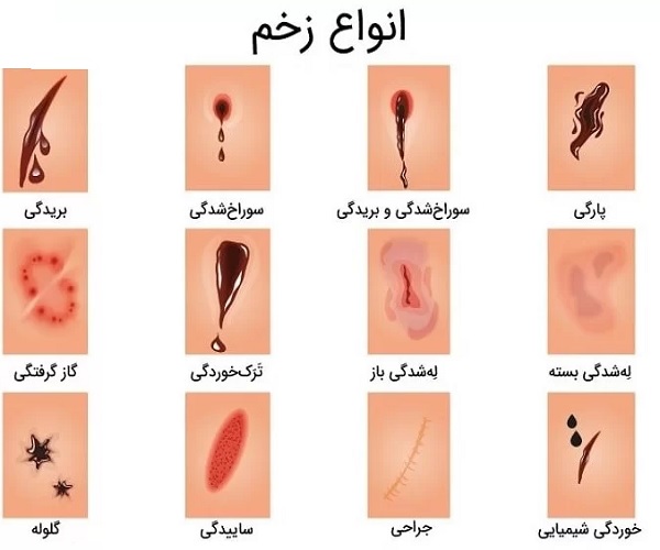 درمان زخم تازه