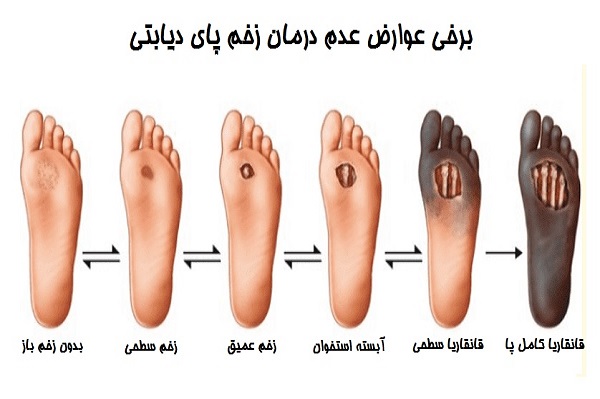 پیشگیری از قانقاریا در بیماران دیابتی