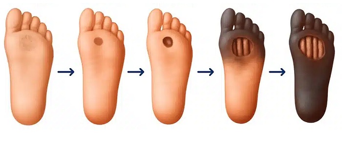 درمان زخم دیابتی در منزل