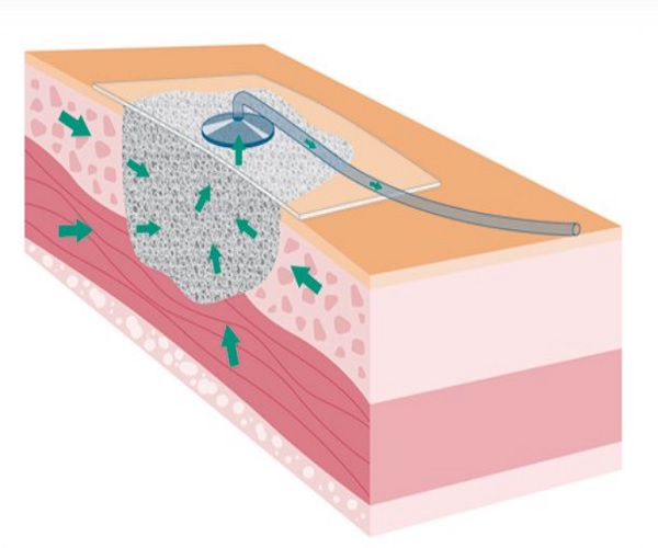 وکیوم تراپی چیست؟