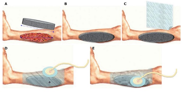وکیوم تراپی چیست؟