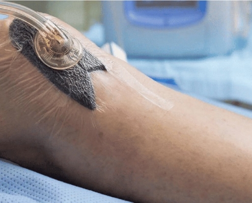 وکیوم تراپی چیست؟