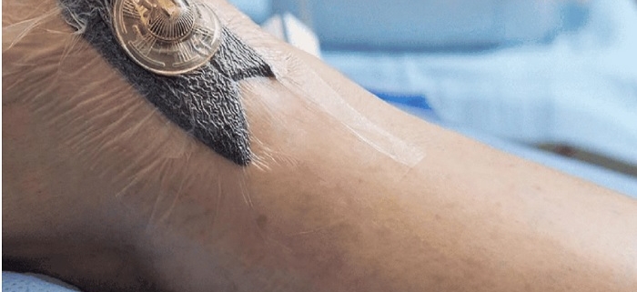 وکیوم تراپی چیست؟