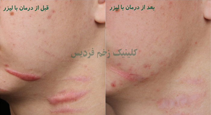 درمان اسکار با لیزر در کرج -لیزر جای زخم فردیس